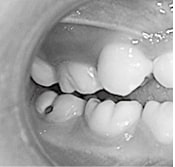 生えてきた時にすでに虫歯になっていた「形成不全歯」の写真